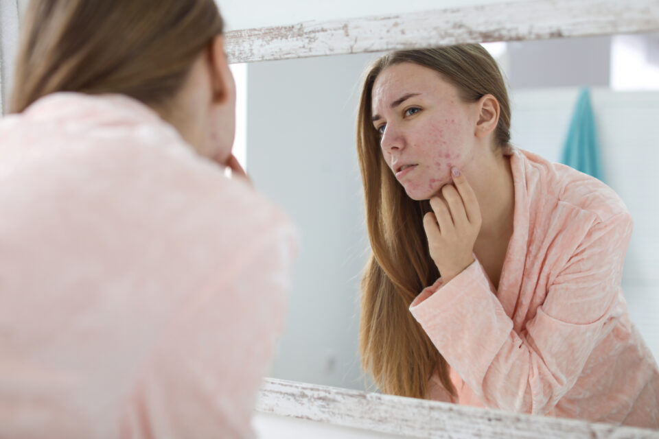 Summer Can Be Acne Season 10 Reasons Why Your Skin May Be Breaking Out